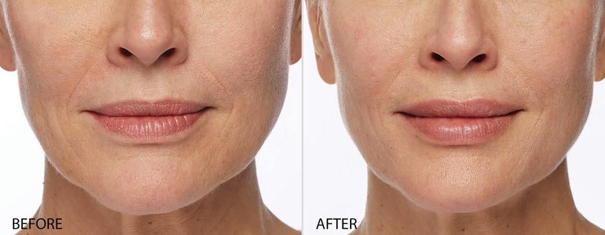 Restylane Before & After