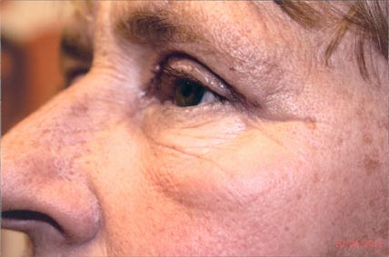 Eyelids after Blepharoplasty