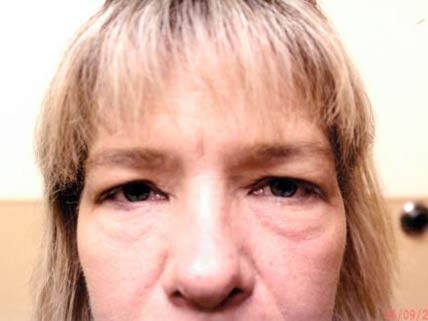 Eyelids prior to Blepharoplasty